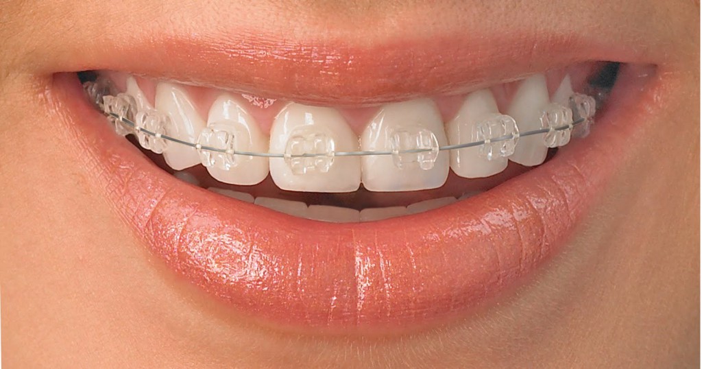 Comment Blanchir Son Appareil Dentaire Transparent appareil-dentaire - Utile et pratique